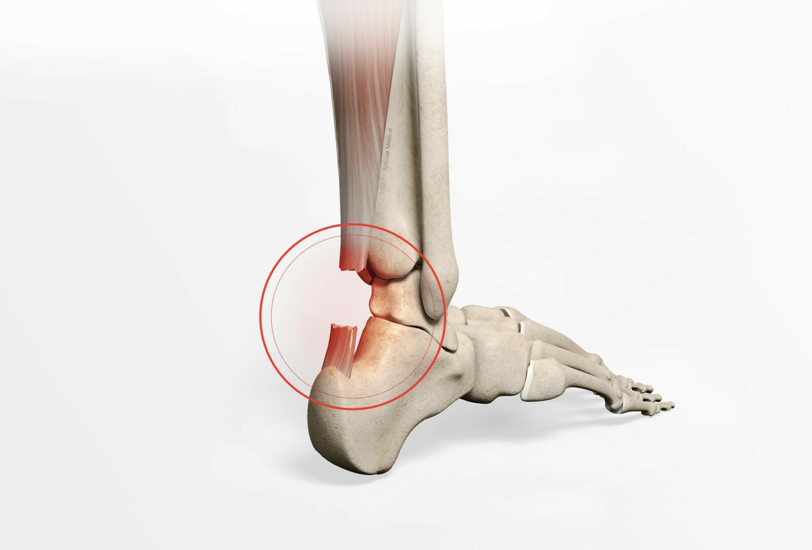 Torn Achilles Tendon Rupture or Achilles Tendonitis? [HOW TO TELL]